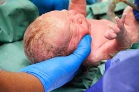 Bersalin Secara Caesarean