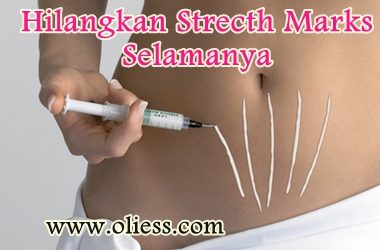 Hilangkan stretch marks besalin dalam 1 bulan